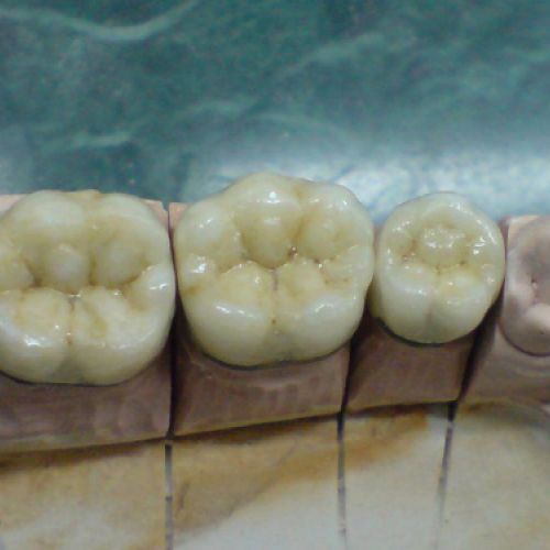 imágenes prótesis dentales