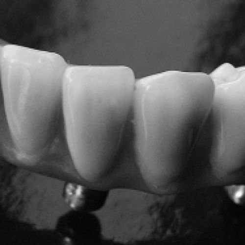 imágenes de prótesis dentales