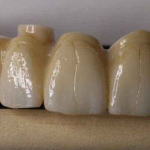 imágenes prótesis dentales