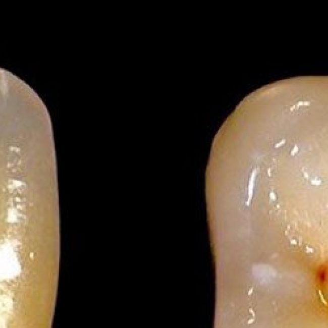 laboratorio de prótesis dentales en Madrid
