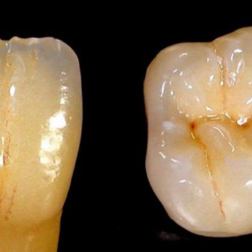 imágenes prótesis dentales