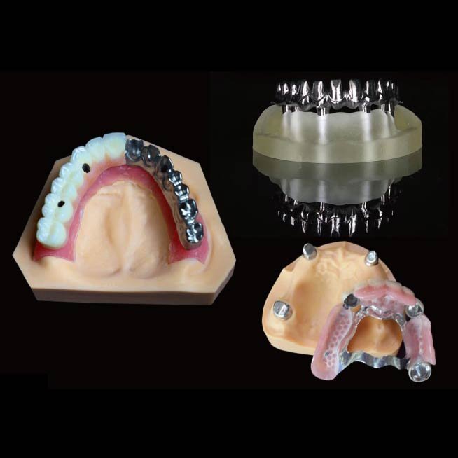 Prótesis dentales fijas en Madrid | Improdent 3000