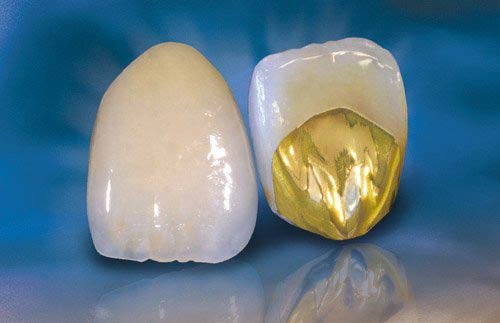 Prótesis dentales a medida