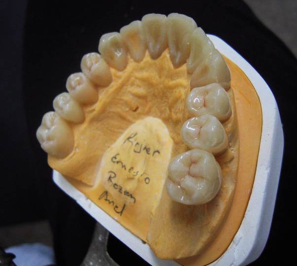 Prótesis dentales a medida en Madrid